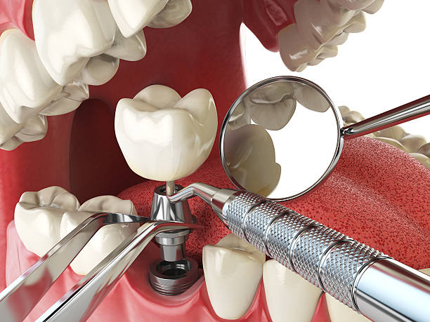 Best Emergency Wisdom Teeth Removal in Cashmere, WA